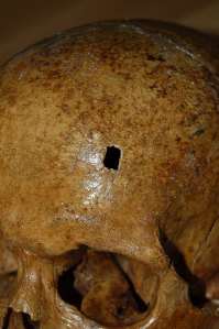 The hole in the skull of the Pope made many speculate in hs possible murder. 